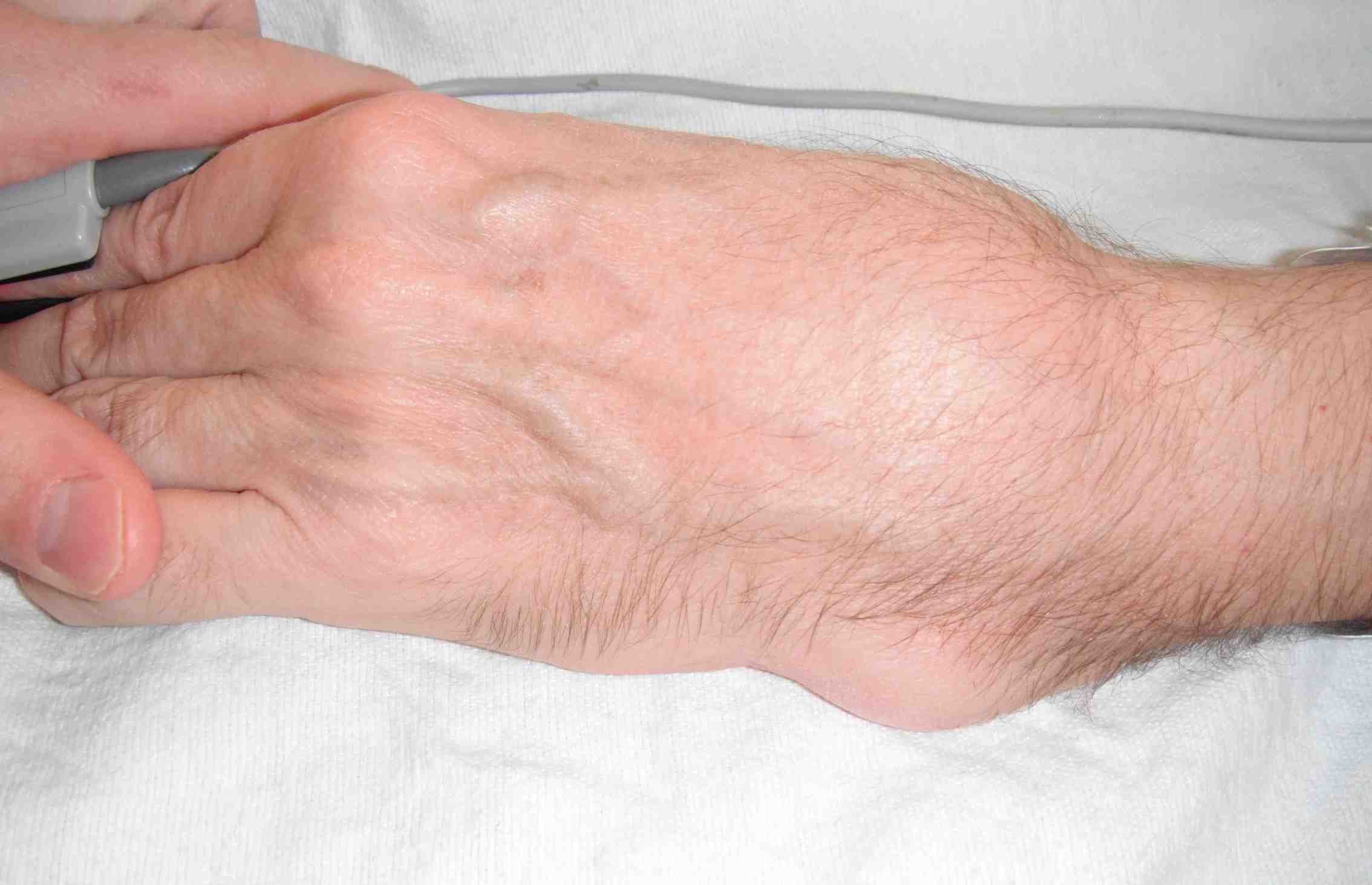 Osteogenesis Imperfecta Wrist